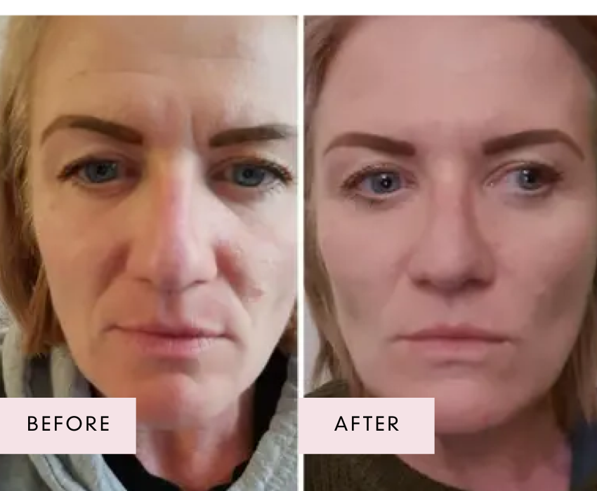 Before and after photos of a woman with blonde hair and blue eyes, showing smoother skin texture, reduced redness, and a more even complexion after using Raw Beauty Lab’s Vegan Collagen.