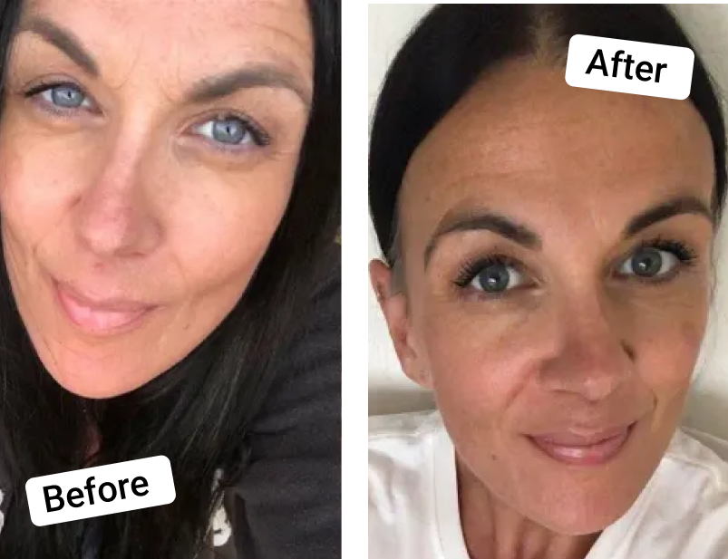 skin collagen before and after