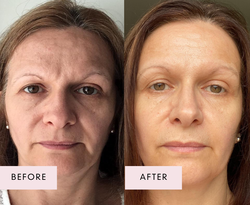 Before and after comparison of a woman showing visibly smoother, brighter skin after using Raw Beauty Lab's Vegan Collagen supplement.